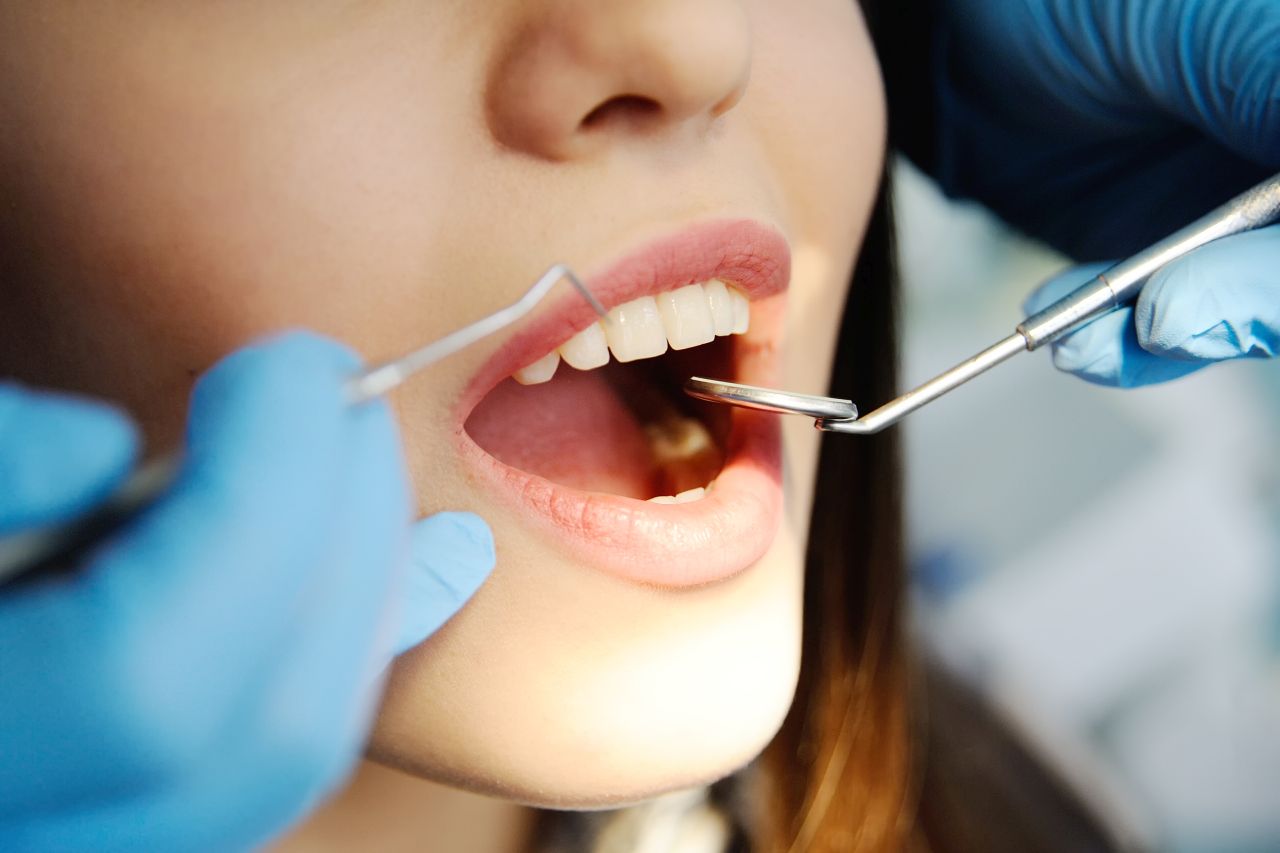 Jak przygotować się do wybielania zębów?
